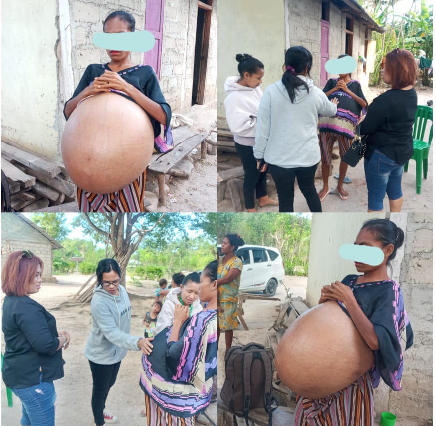 Kisah Pilu Warga TTS 4 Tahun Menderita Tumor dan Kedua Orang Tua Telah Tiada 